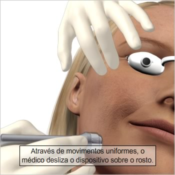 Preparação para o procedimento Um procedimento de microdermoabrasão pode durar cerca de trinta a quarenta e cinco minutos.