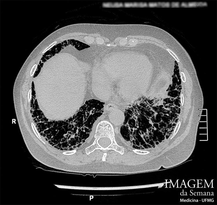 Imagem da Semana: Radiografia, Tomografia Computadorizada, Ressonância Nuclear Magnética Figura
