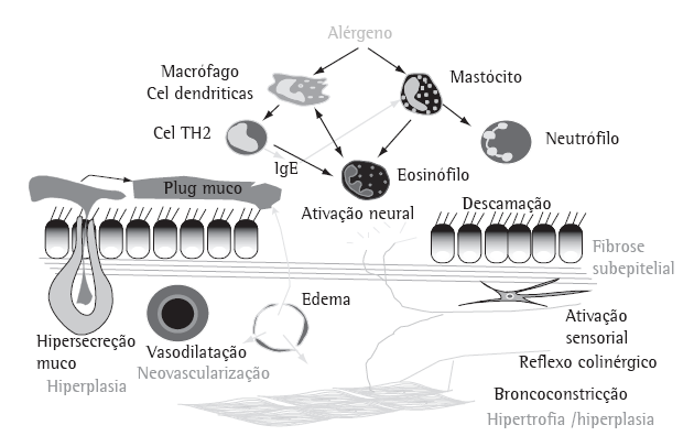Patogenia Manutenção da inflamação e remodelamento brônquico Macrófago TNF Linfo Th2 IL-4 IgE Linfo T