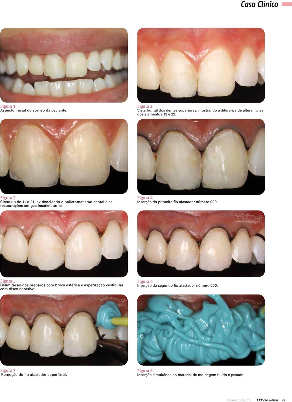 Figura 3 Close-up do 11 e 21, evidenciando o policromatismo dental e as restaurações antigas insatisfatórias.