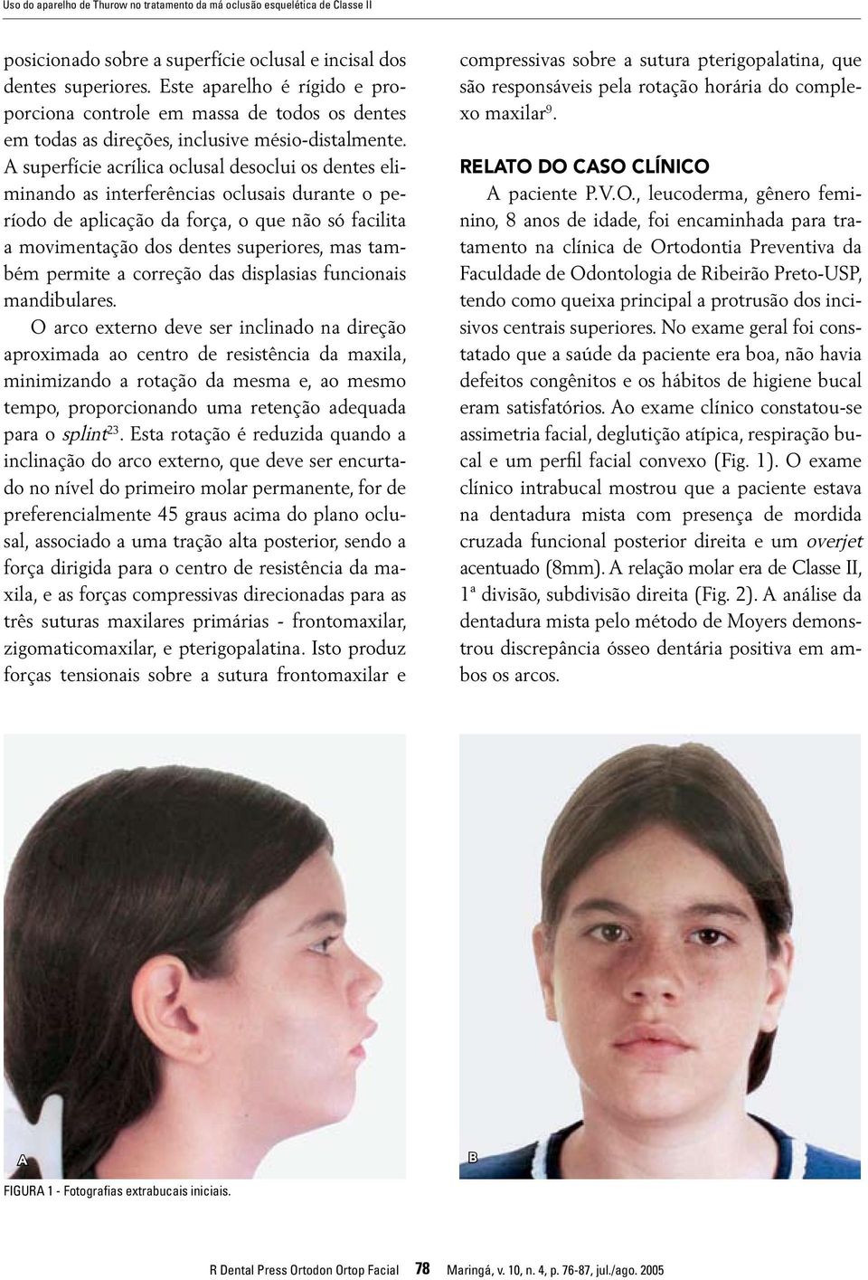 A superfície acrílica oclusal desoclui os dentes eliminando as interferências oclusais durante o período de aplicação da força, o que não só facilita a movimentação dos dentes superiores, mas também