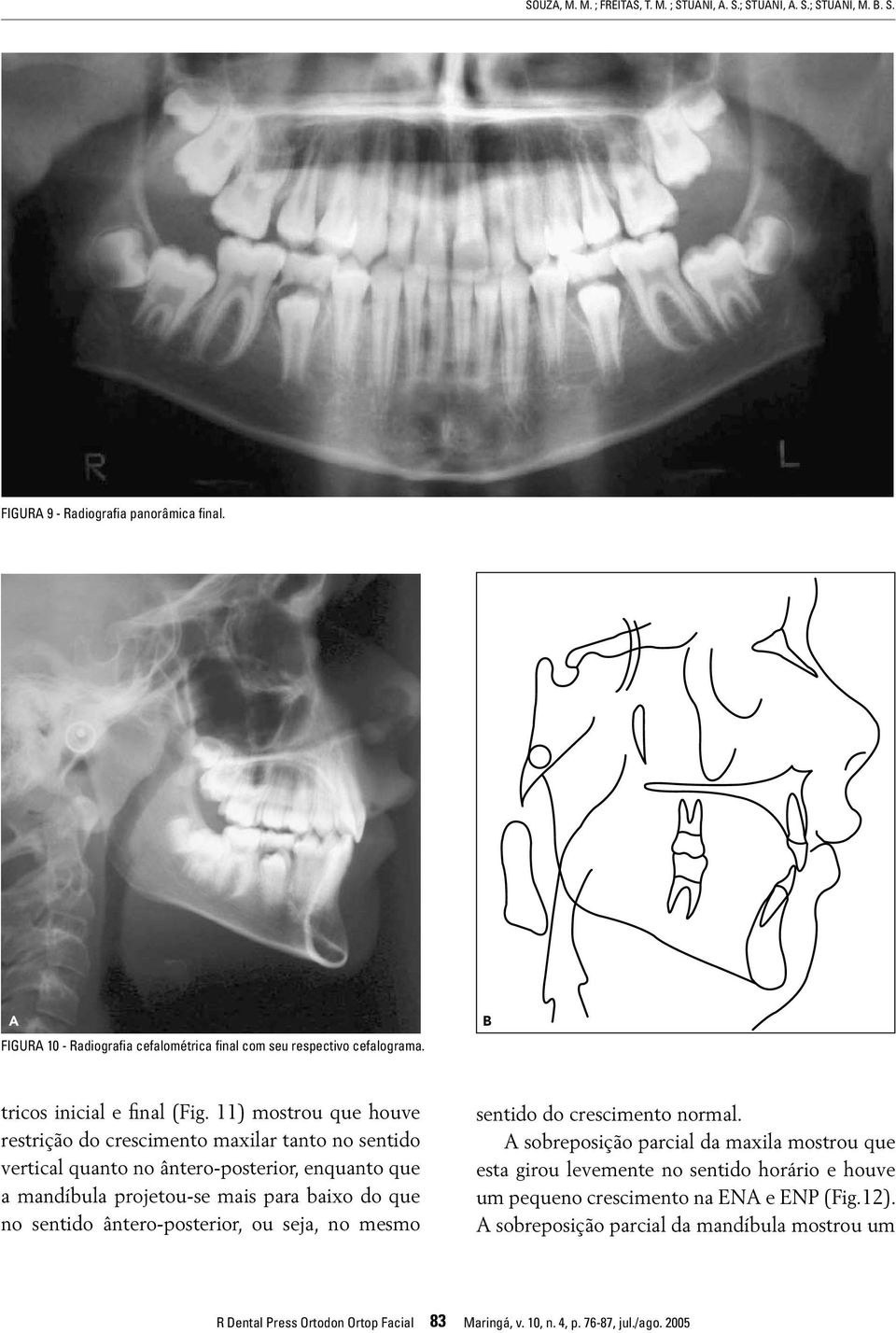 11) mostrou que houve restrição do crescimento maxilar tanto no sentido vertical quanto no ântero-posterior, enquanto que a mandíbula projetou-se mais para baixo do que no sentido