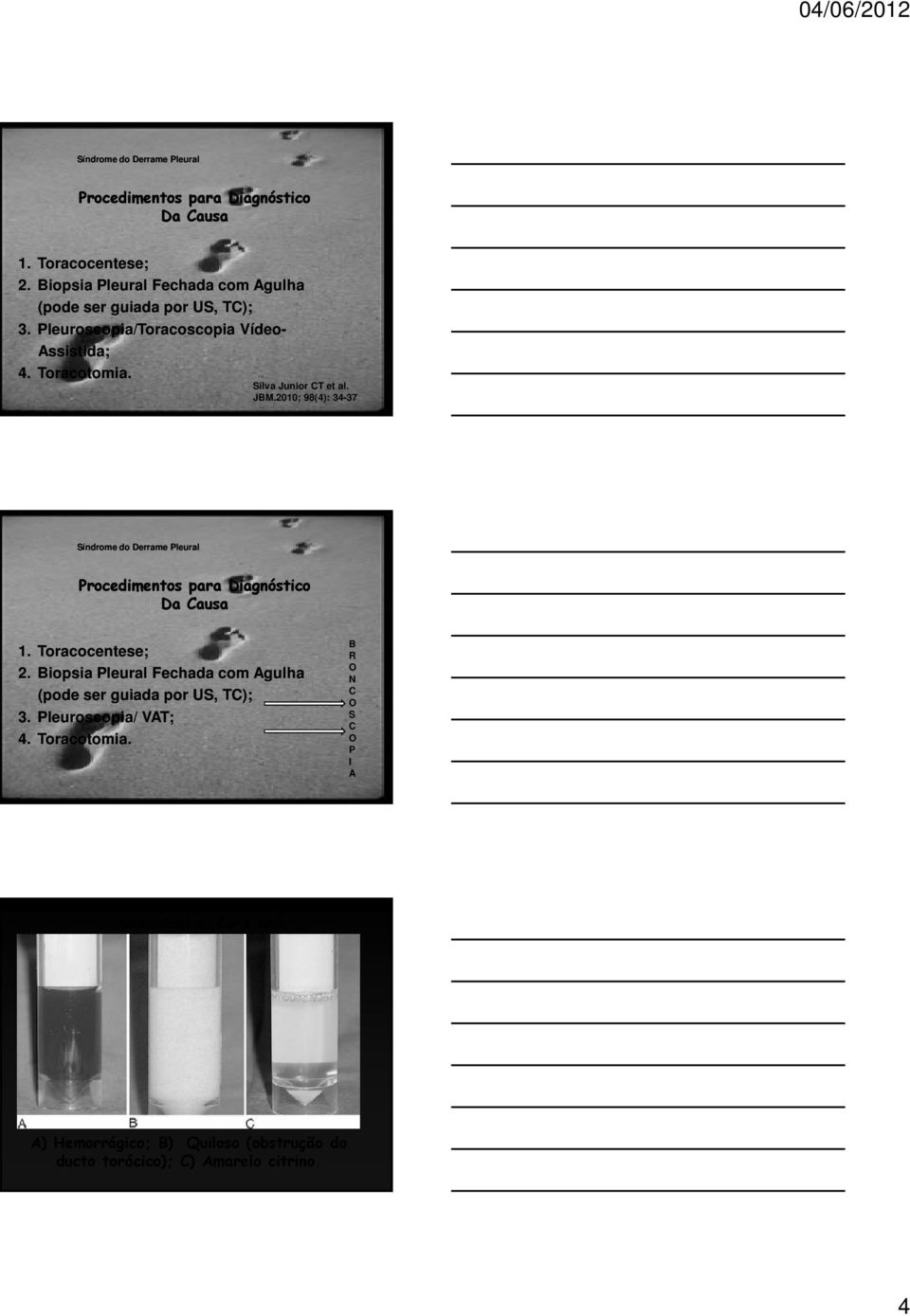 Silva Junior CT et al. JBM.2010; 98(4): 34-37  Pleuroscopia/ VAT; 4. Toracotomia.