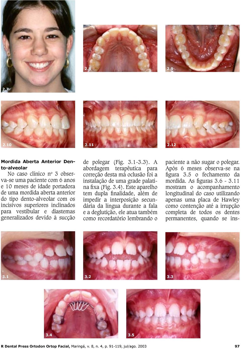 superiores inclinados para vestibular e diastemas generalizados devido à sucção de polegar (Fig. 3.1-3.3).