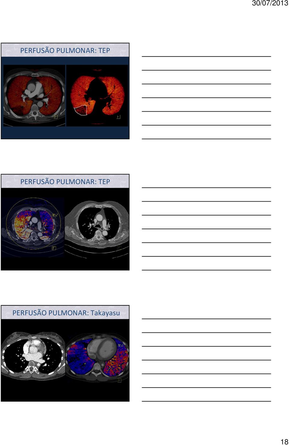 Indicações PULMONAR: