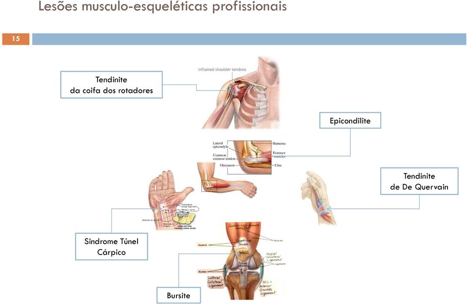 dos rotadores Epicondilite Tendinite