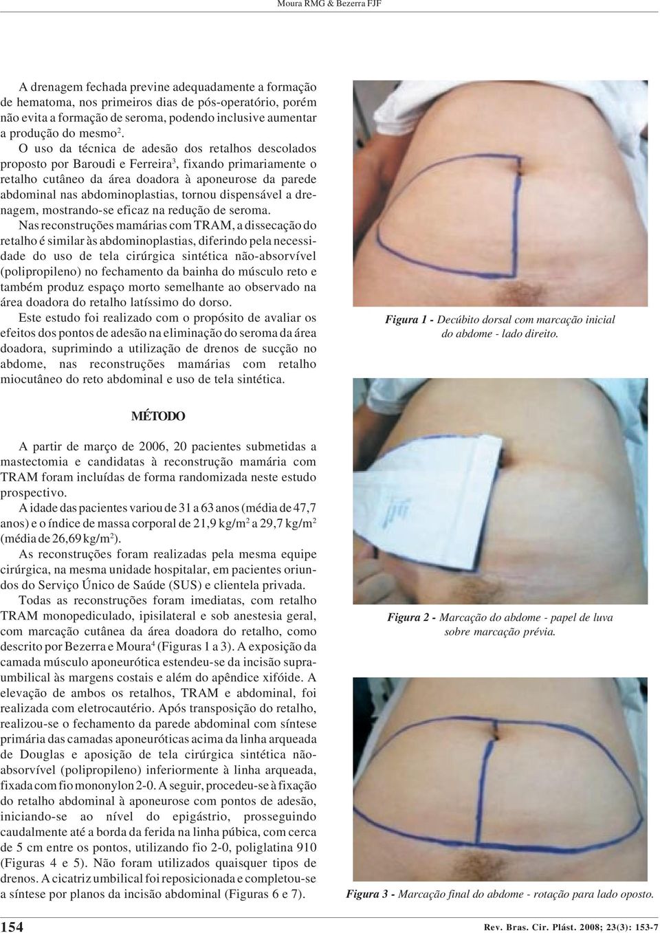 O uso da técnica de adesão dos retalhos descolados proposto por Baroudi e Ferreira 3, fixando primariamente o retalho cutâneo da área doadora à aponeurose da parede abdominal nas abdominoplastias,