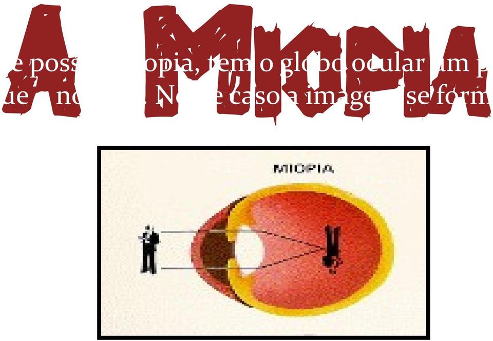 - Formação da imagem de uma pessoa míope Para corrigir a miopia usa-se lente divergente para diminuir a convergência dos raios