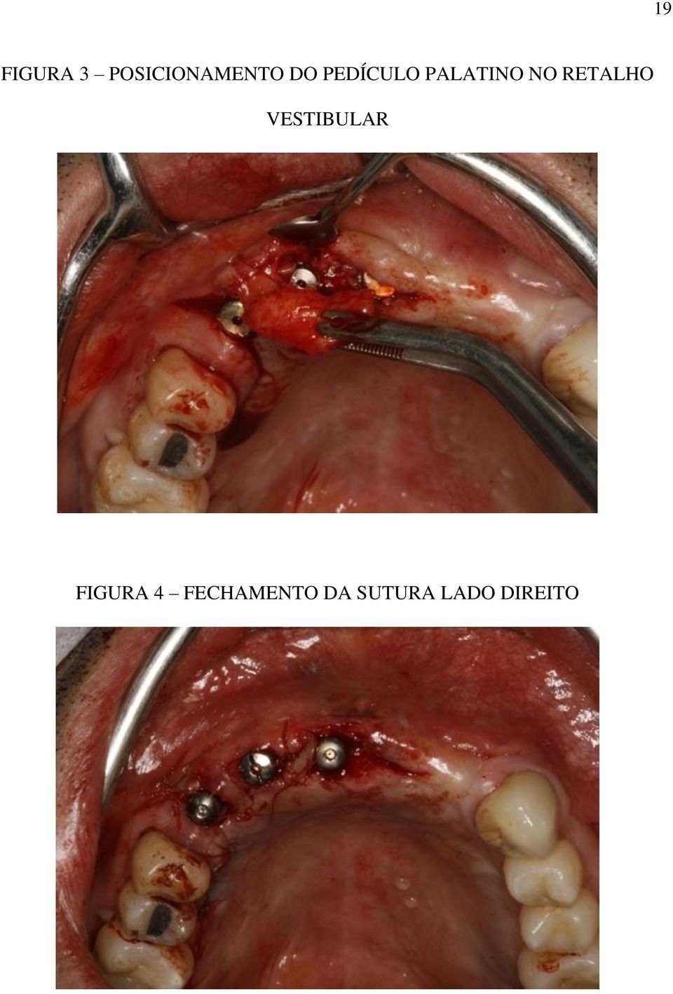 RETALHO VESTIBULAR FIGURA 4