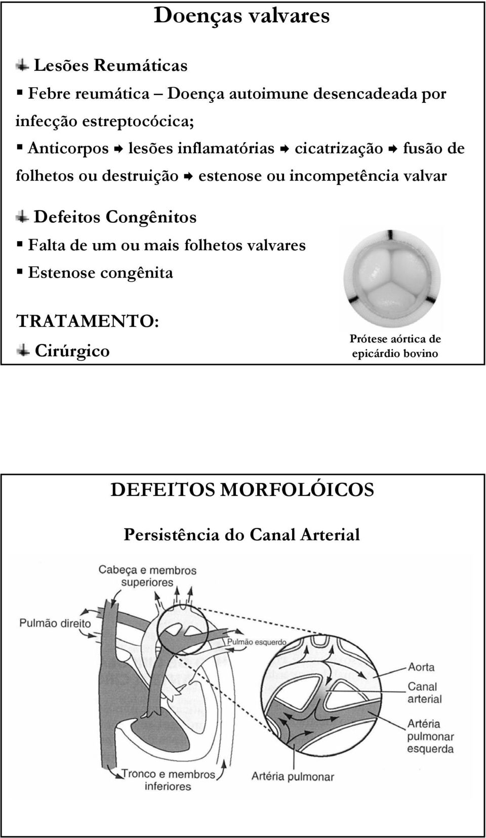 ou incompetência valvar Defeitos Congênitos Falta de um ou mais folhetos valvares Estenose congênita