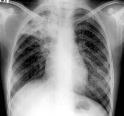 Repetir TRM INVESTIGAÇÃO DE TB EM RETRATAMENTOS (RECIDIVA OU RETORNO APÓS ABANDONO) PNCT/SVS/MS 2014 Resistência a Rifampicina Não Detectada Iniciar tratamento para TB com EB (aguardar cultura e TSA)