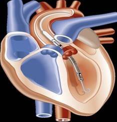 Assistência Ventricular Fração de ejeção menor que 30%