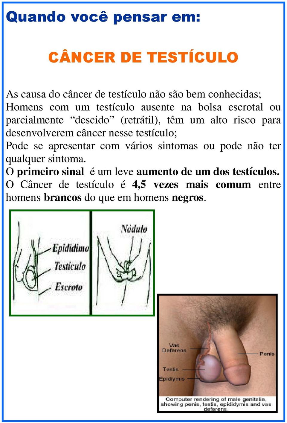 nesse testículo; Pode se apresentar com vários sintomas ou pode não ter qualquer sintoma.