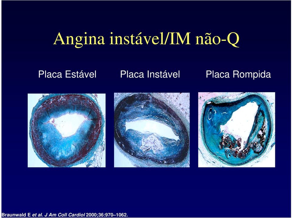 Rompida Braunwald E et al.