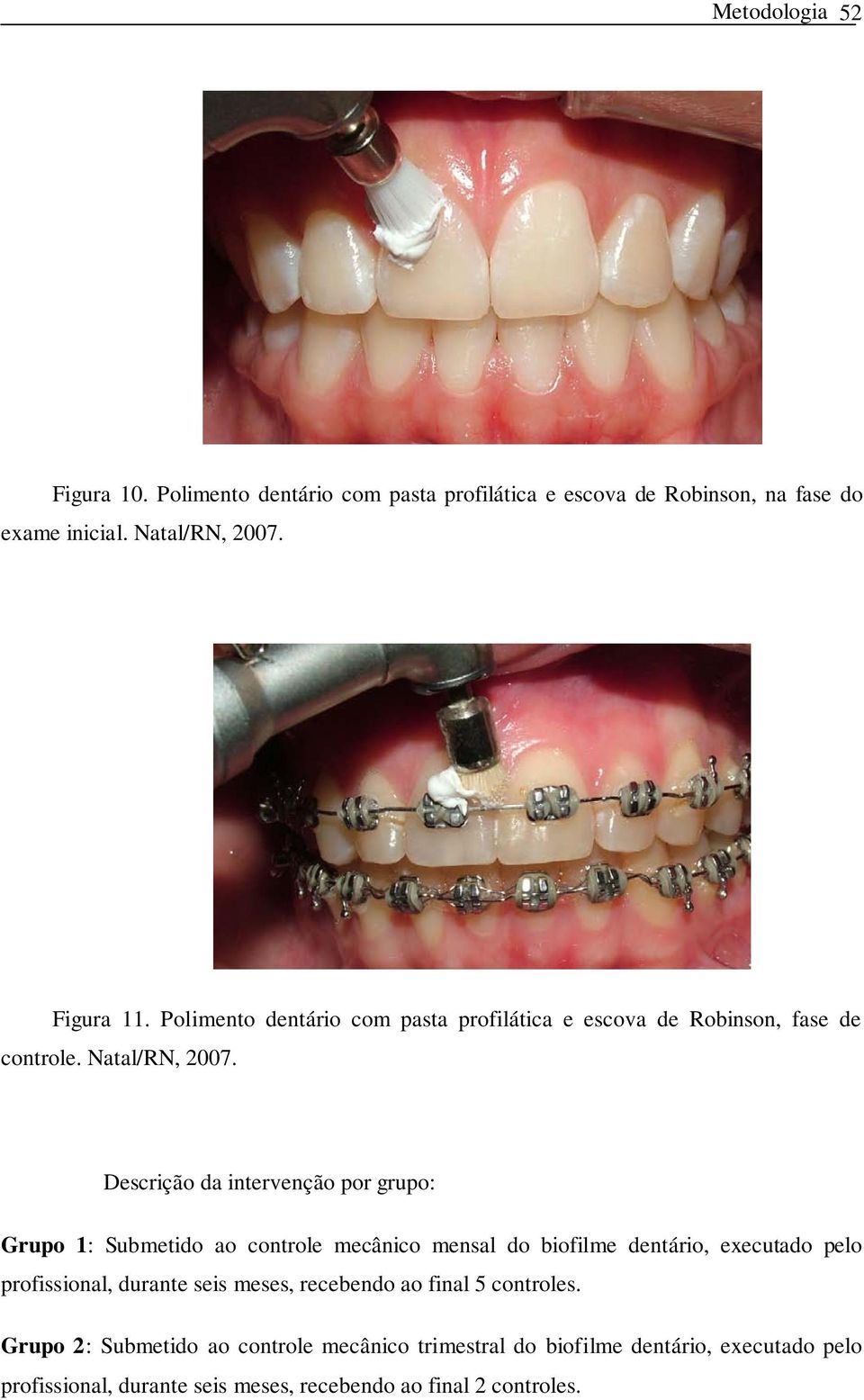 Descrição da intervenção por grupo: Grupo 1: Submetido ao controle mecânico mensal do biofilme dentário, executado pelo profissional, durante