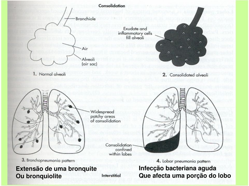 bronquiolite Infecção