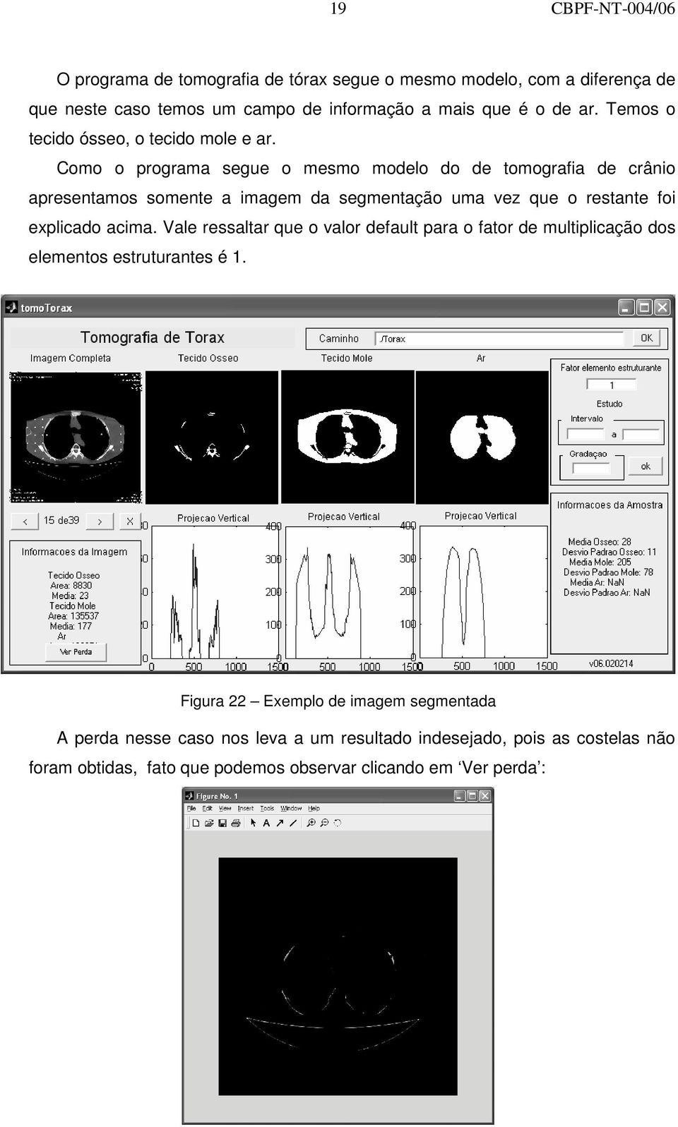 Como o programa segue o mesmo modelo do de tomografia de crânio apresentamos somente a imagem da segmentação uma vez que o restante foi explicado acima.