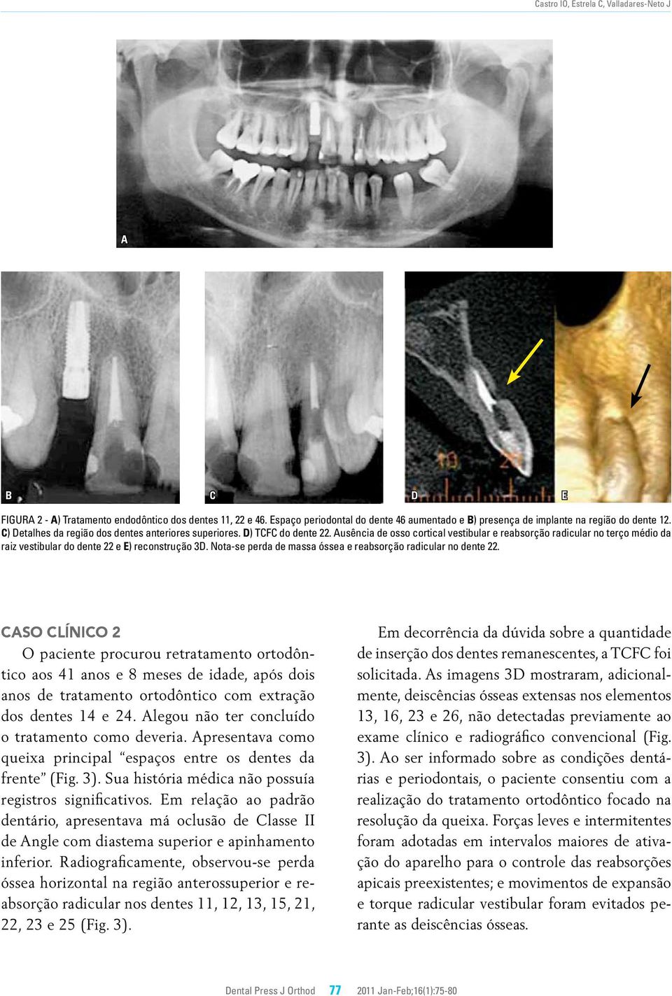 Ausência de osso cortical vestibular e reabsorção radicular no terço médio da raiz vestibular do dente 22 e E) reconstrução 3D. Nota-se perda de massa óssea e reabsorção radicular no dente 22.