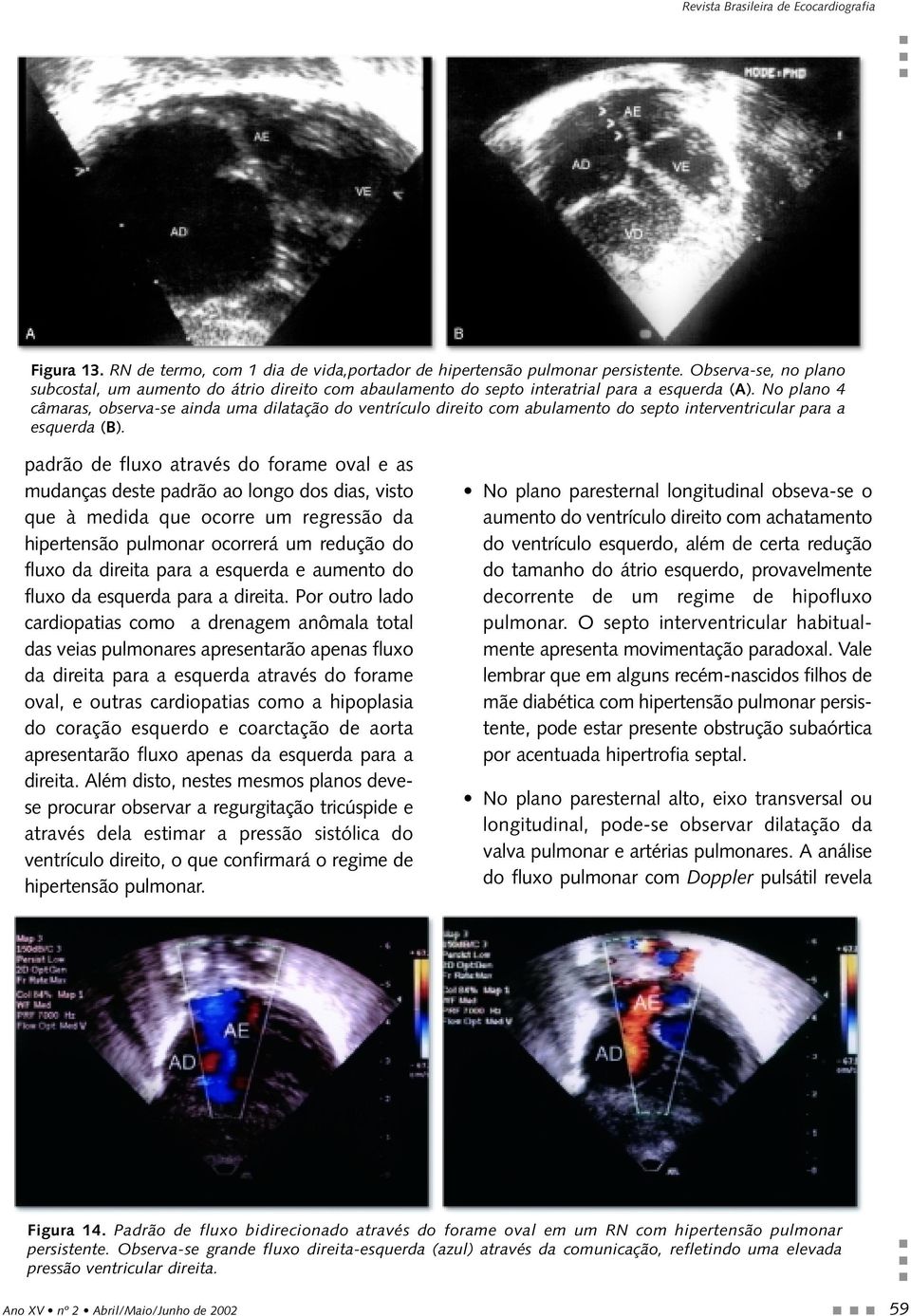 No plano 4 câmaras, observa-se ainda uma dilatação do ventrículo direito com abulamento do septo interventricular para a esquerda (B).