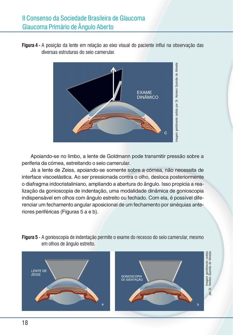 Já a lente de Zeiss, apoiando-se somente sobre a córnea, não necessita de interface viscoelástica.