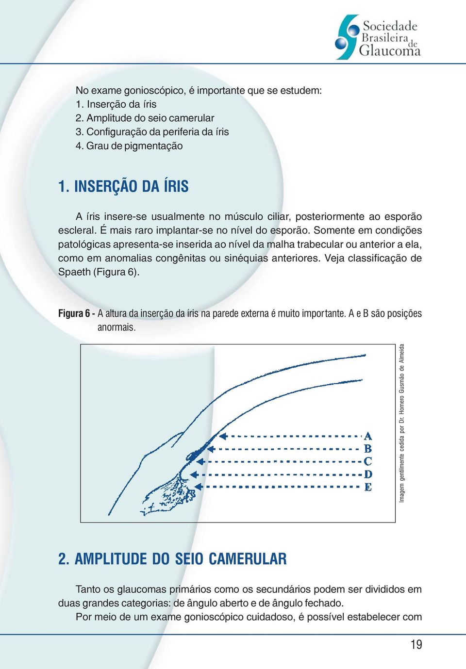 Somente em condições patológicas apresenta-se inserida ao nível da malha trabecular ou anterior a ela, como em anomalias congênitas ou sinéquias anteriores. Veja classificação de Spaeth (Figura 6).