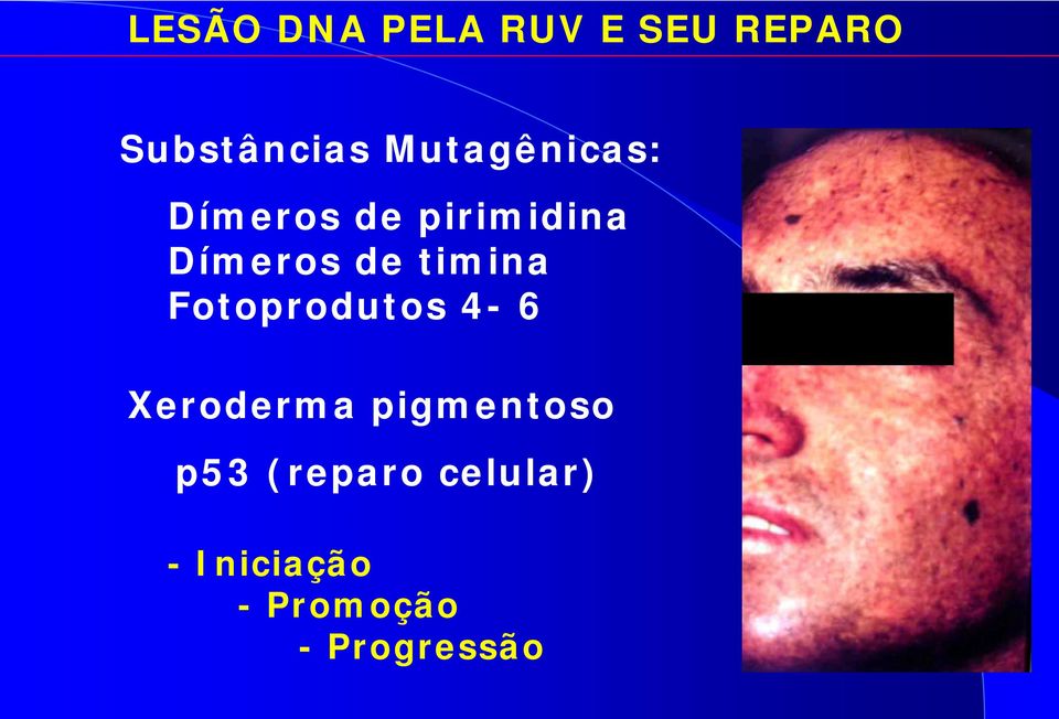 timina Fotoprodutos 4-6 Xeroderma pigmentoso