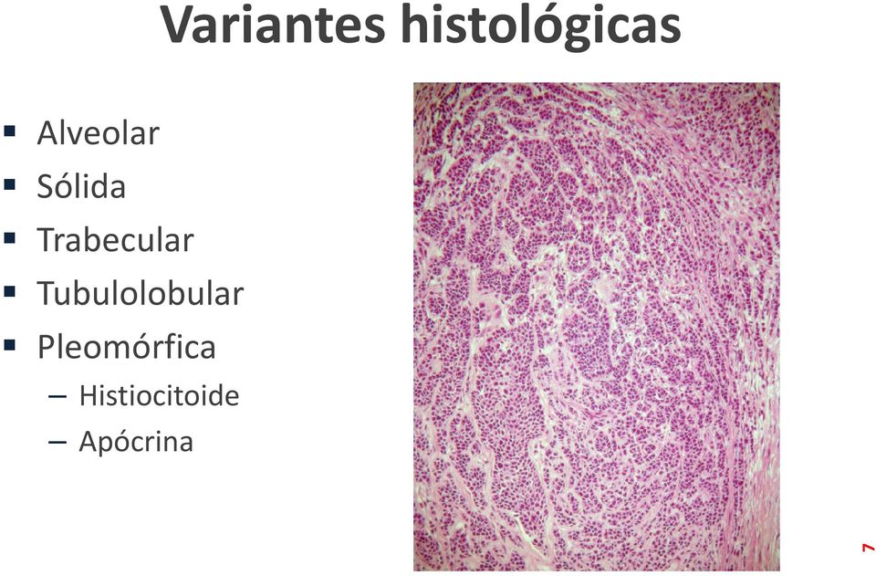 Trabecular Tubulolobular