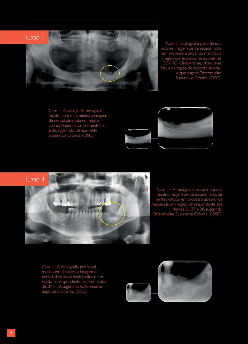 Caso I - A radiografia periapical mostra com mais nitidez a imagem de densidade mista em região correspondente aos elementos 35 e 36, sugerindo Osteomielite Supurativa Crônica, (OSC).