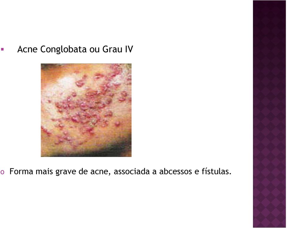 grave de acne,