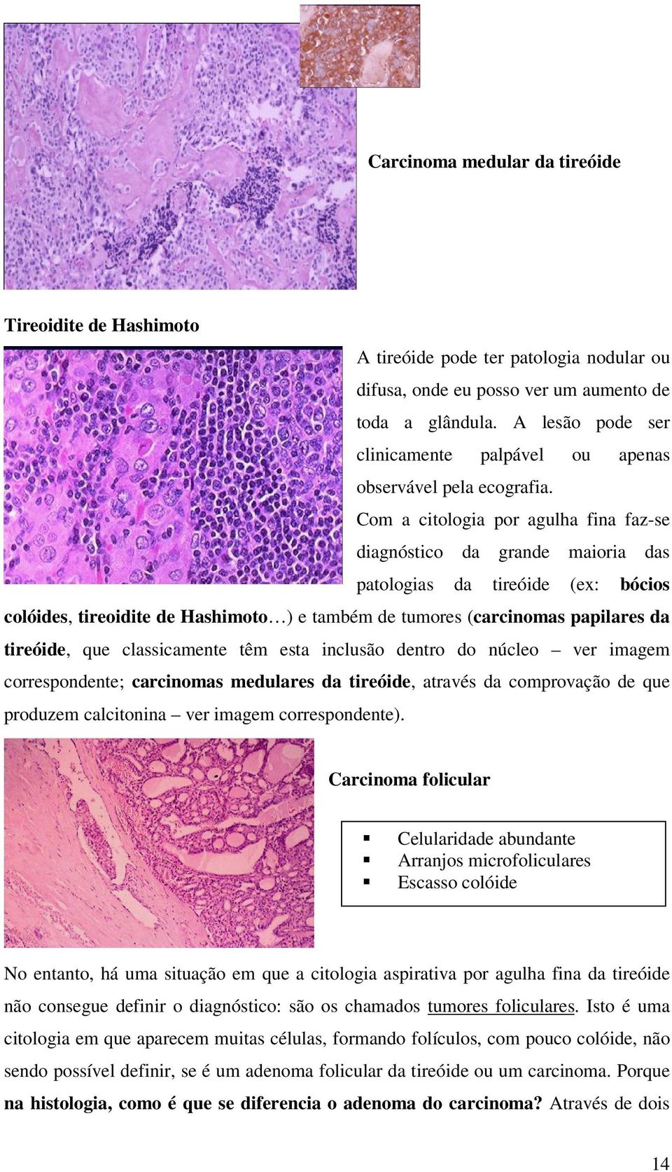 Com a citologia por agulha fina faz-se diagnóstico da grande maioria das patologias da tireóide (ex: bócios colóides, tireoidite de Hashimoto ) e também de tumores (carcinomas papilares da tireóide,