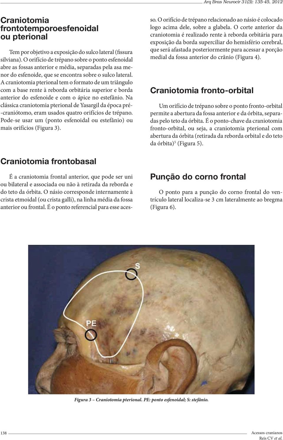 A craniotomia pterional tem o formato de um triângulo com a base rente à reborda orbitária superior e borda anterior do esfenoide e com o ápice no estefânio.