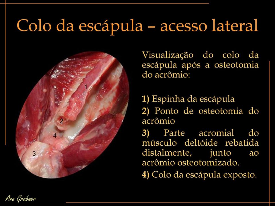 osteotomia do acrômio 3) Parte acromial do músculo deltóide