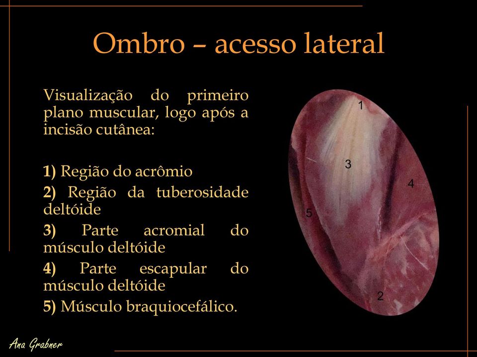 tuberosidade deltóide 3) Parte acromial do músculo deltóide 4)