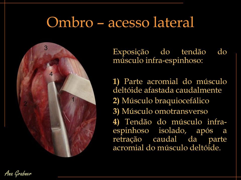 braquiocefálico 3) Músculo omotransverso 4) Tendão do músculo