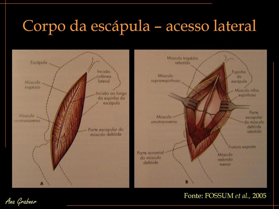 acesso lateral