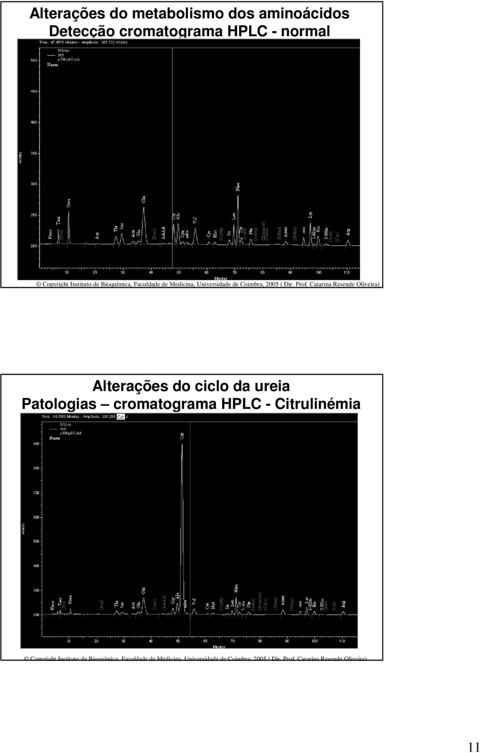 Catarina Resende Oliveira) Alterações do ciclo da ureia Patologias cromatograma HPLC - Citrulinémia
