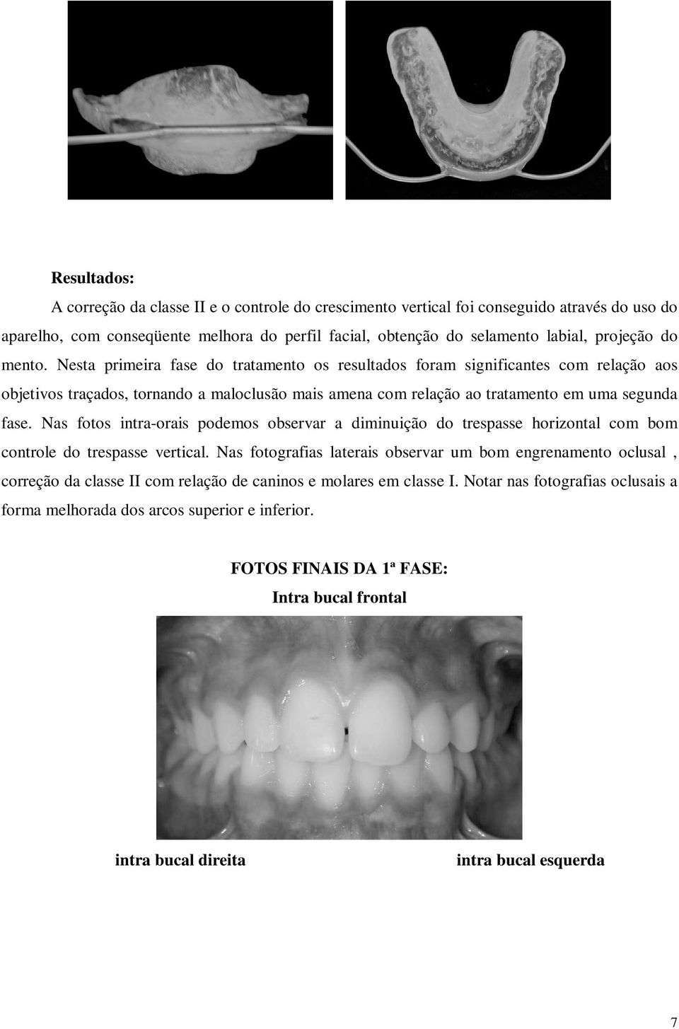 Nas fotos intra-orais podemos observar a diminuição do trespasse horizontal com bom controle do trespasse vertical.