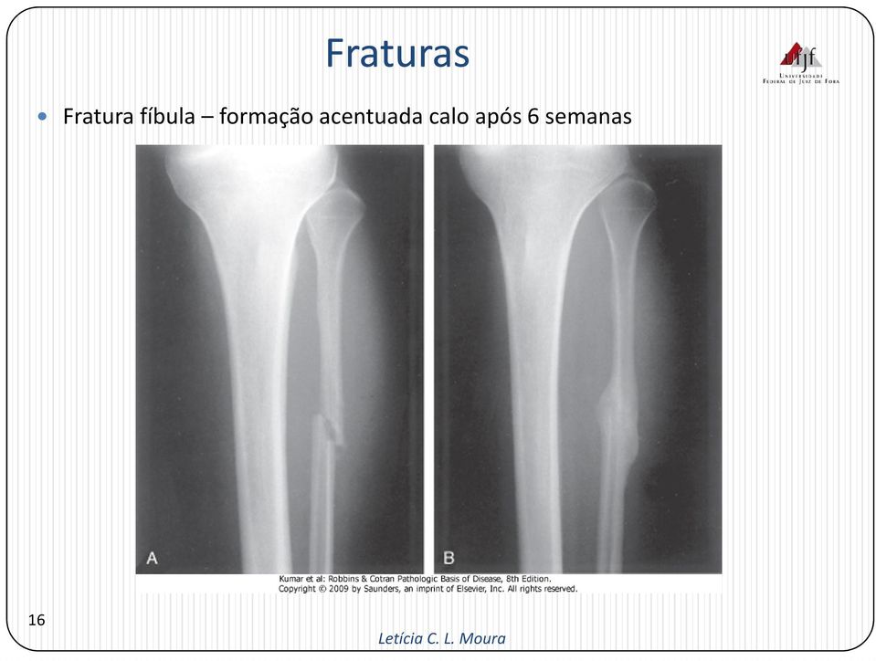 acentuada calo