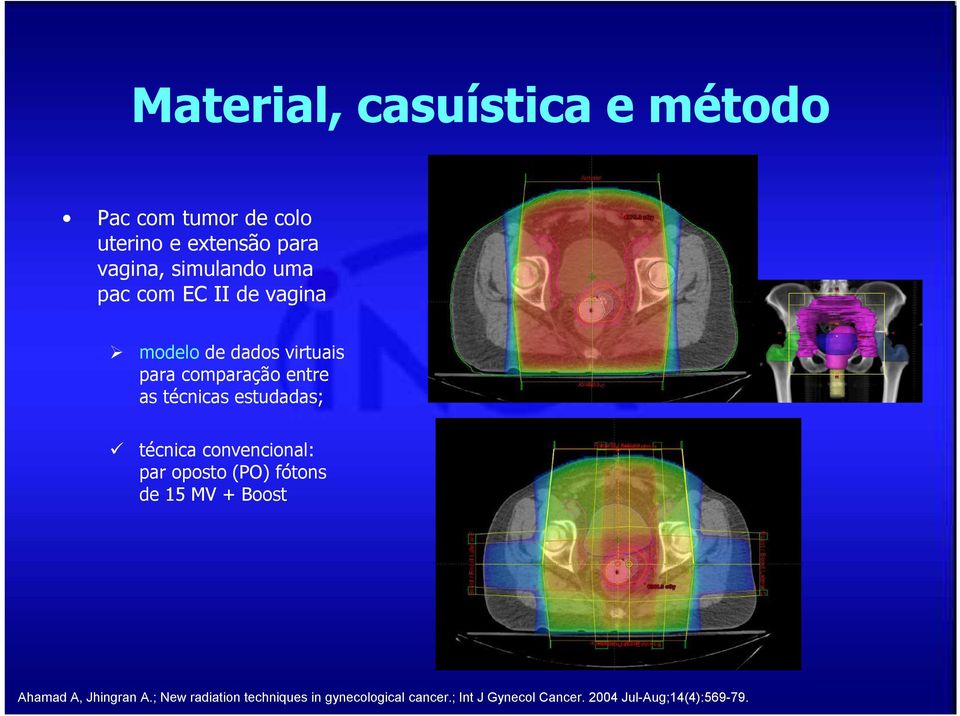 estudadas; técnica convencional: par oposto (PO) fótons de 15 MV + Boost Ahamad A, Jhingran A.