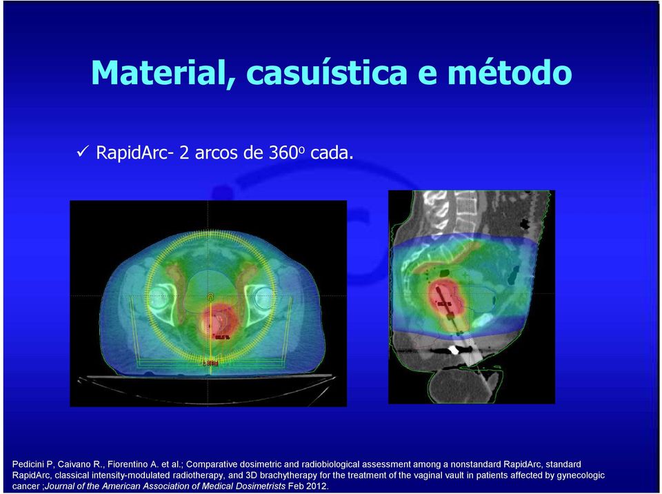 classical intensity-modulated radiotherapy, and 3D brachytherapy for the treatment of the vaginal vault in