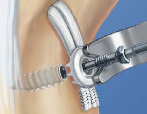 A fixação do tendão com o Parafuso Tibila Acufex e Siked Washer é um método de fixação exclusivo que obtém uma fixação sólida de tecido no osso esponjoso.