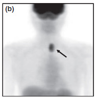 Right thyroid nodule with focal radiotracer uptake (arrow),