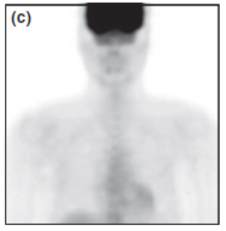 nodule with focal radiotracer uptake, histological diagnosis: benign