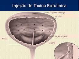 Toxina Botulínica. Toxina tipo A injetada por cistoscopia em múltiplos pontos da parede vesical. Dose de 100-500UI (média de 100-200UI).