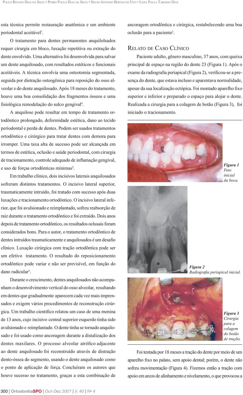 Uma alternativa foi desenvolvida para salvar um dente anquilosado, com resultados estéticos e funcionais aceitáveis.