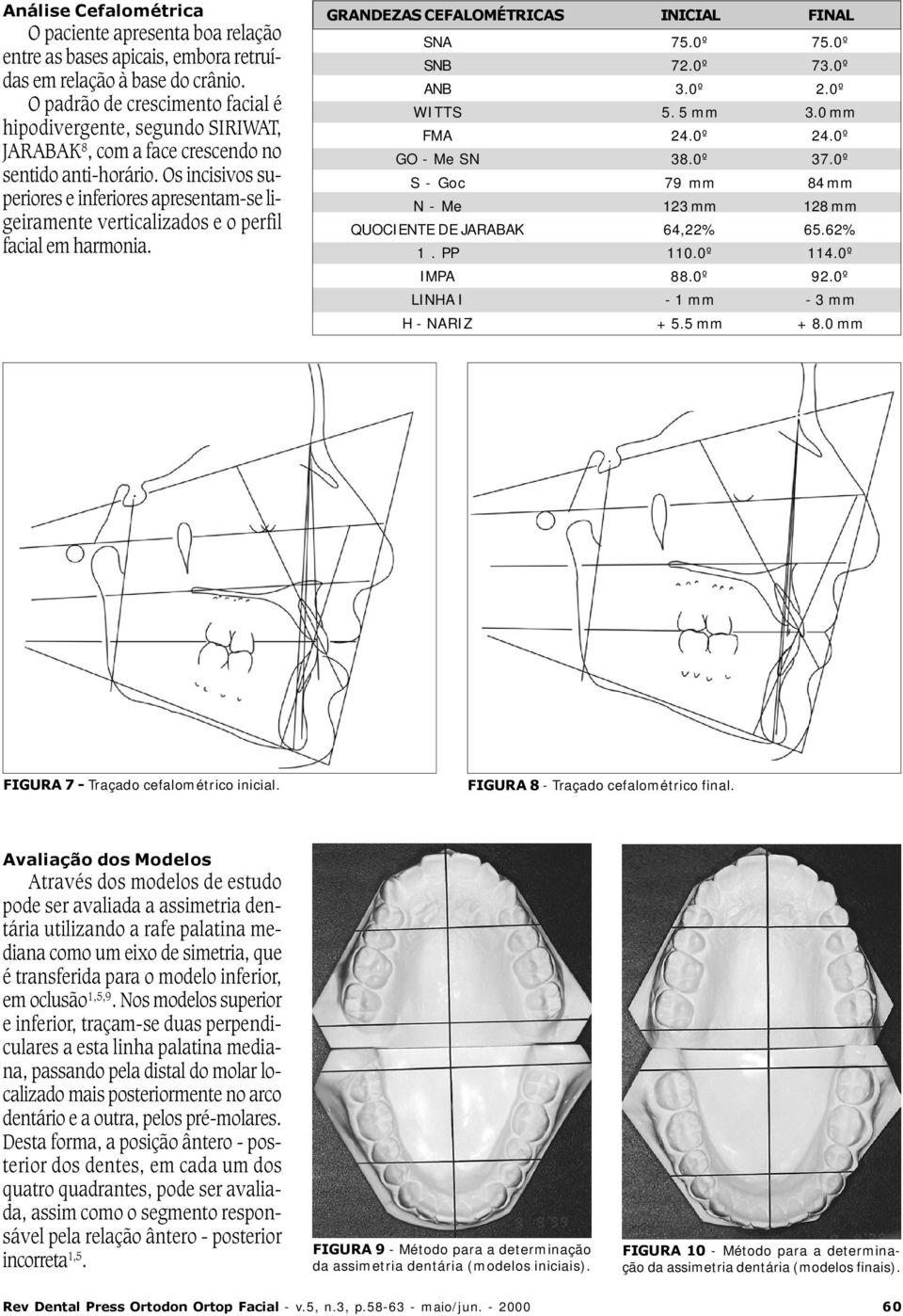 Os incisivos superiores e inferiores apresentam-se ligeiramente verticalizados e o perfil facial em harmonia. GRNDEZS CEFLOMÉTRICS INICIL FINL SN 75.0º 75.0º SN 72.0º 73.0º N 3.0º 2.0º WITTS 5.