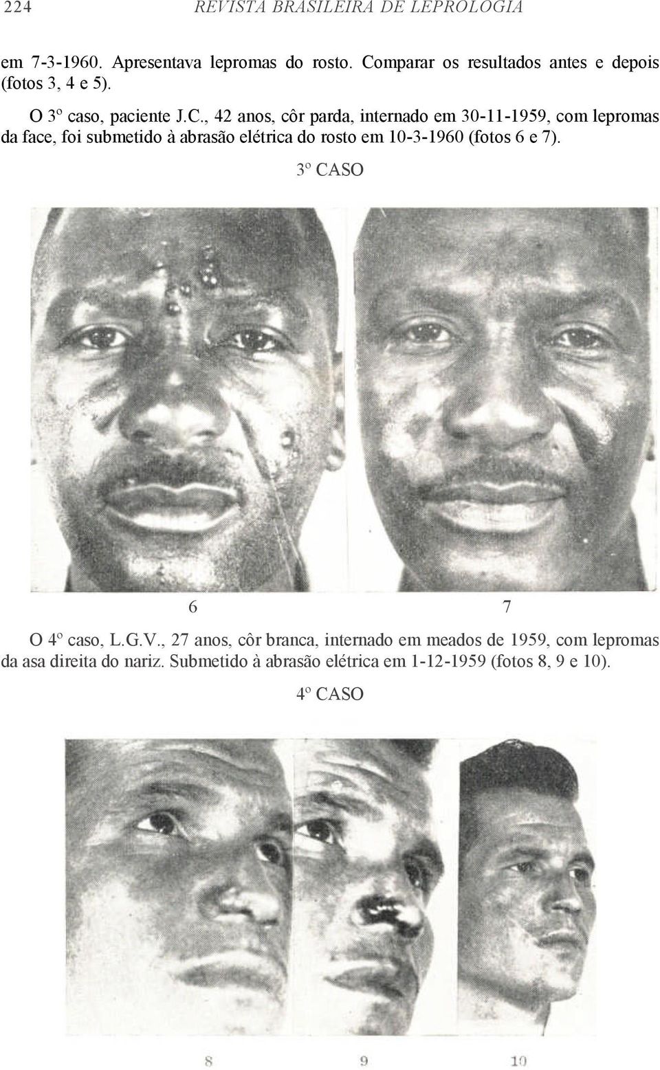 30-11-1959, com lepromas da face, foi submetido à abrasão elétrica do rosto em 10-3-1960 (fotos 6 e 7).