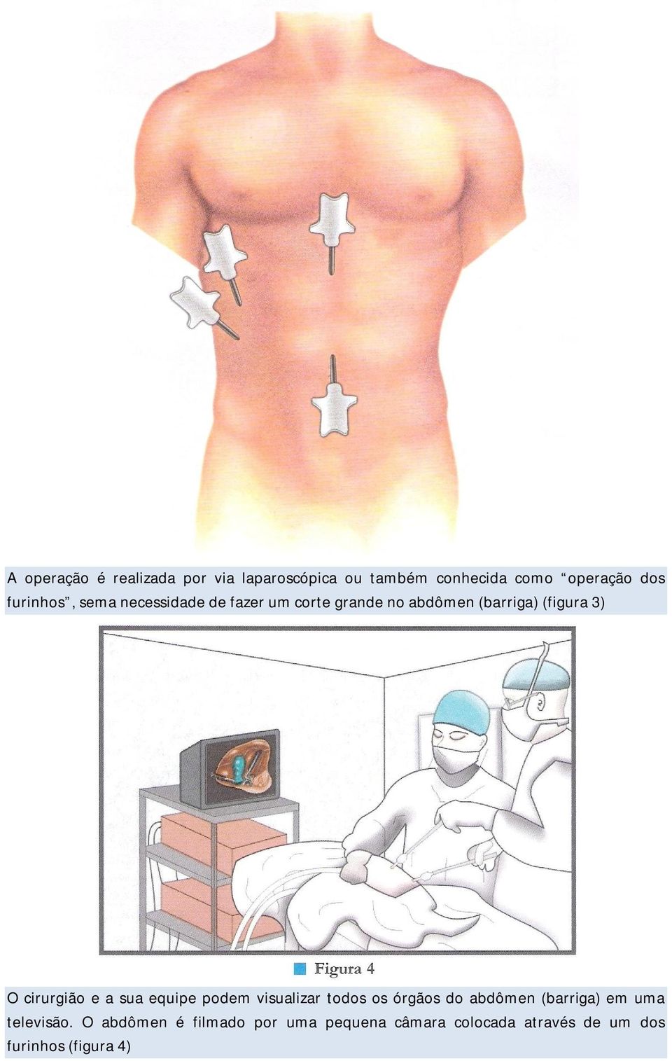 cirurgião e a sua equipe podem visualizar todos os órgãos do abdômen (barriga) em uma