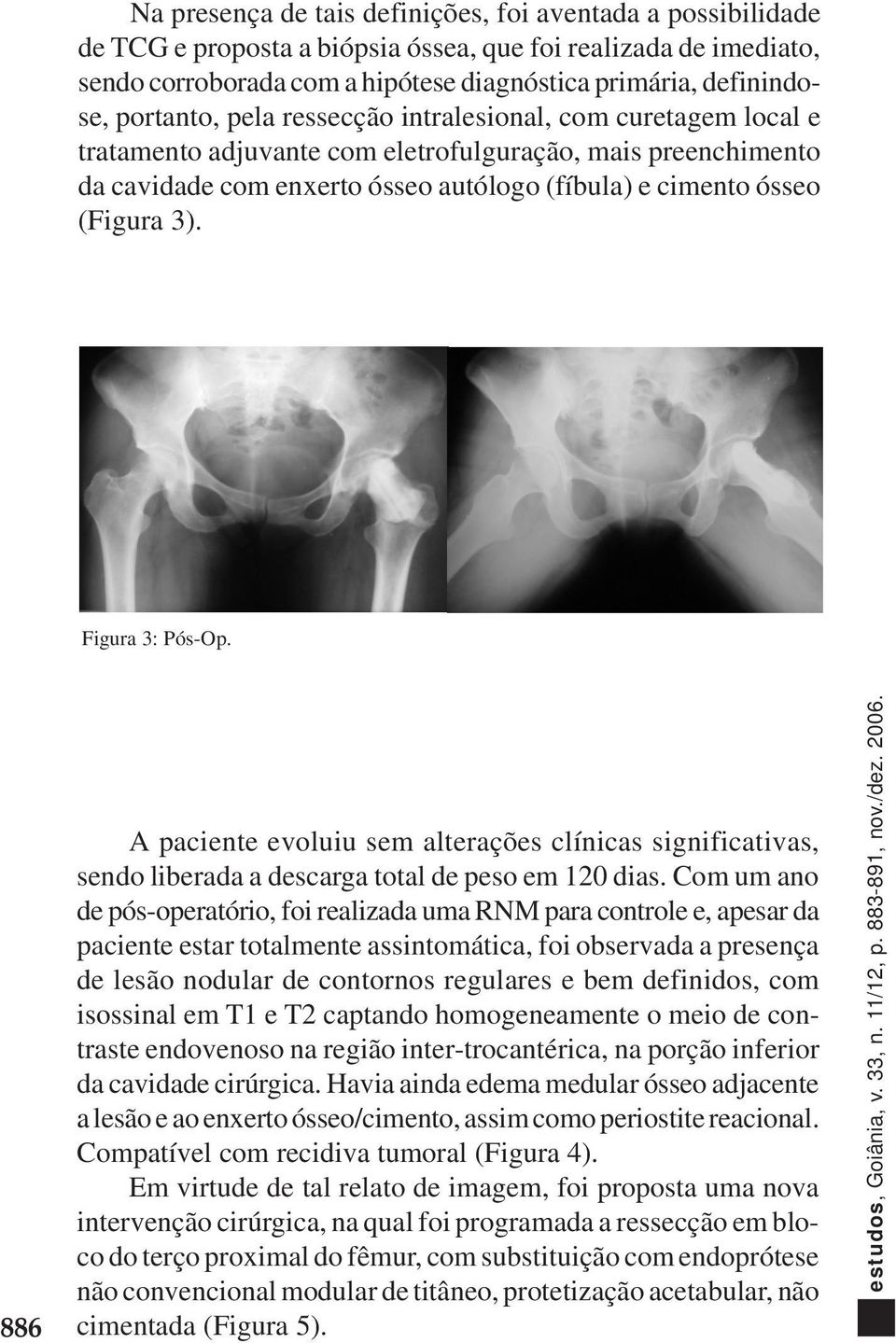 Figura 3: Pós-Op. 886 A paciente evoluiu sem alterações clínicas significativas, sendo liberada a descarga total de peso em 120 dias.