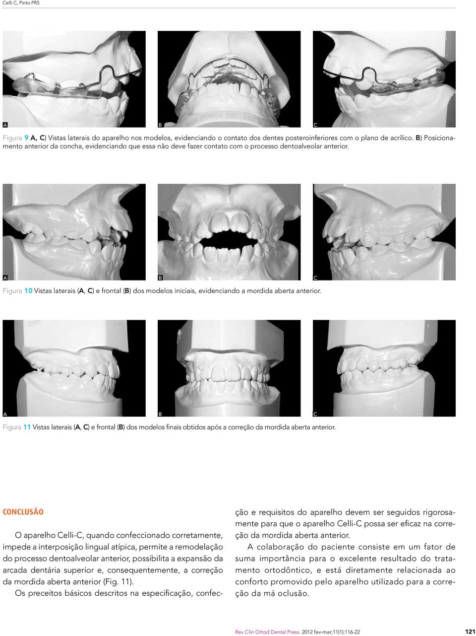 C Figura 10 Vistas laterais (, C) e frontal () dos modelos iniciais, evidenciando a mordida aberta anterior.